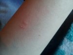 Toothless bite.jpg